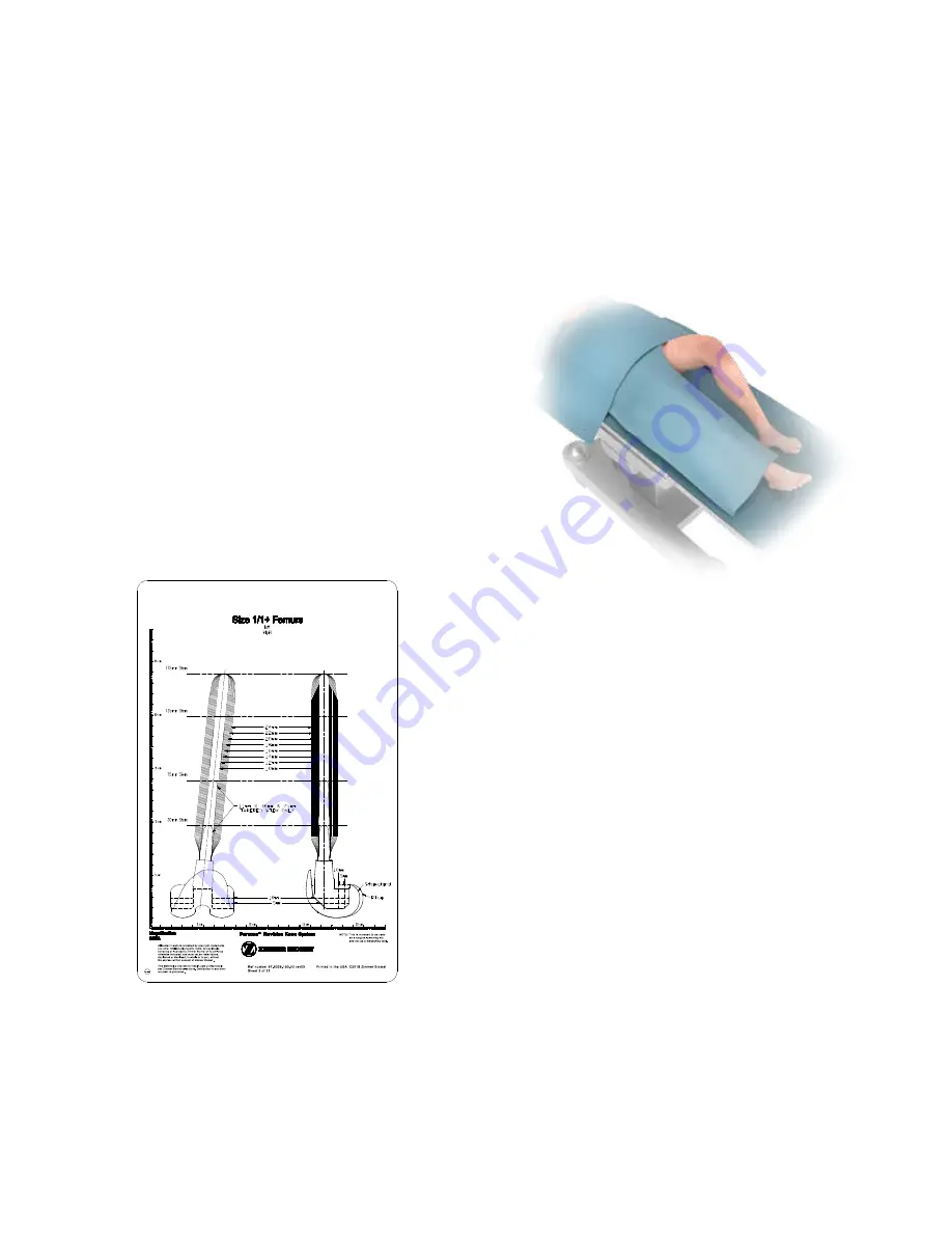 Zimmer Biomet Persona Surgical Technique Download Page 9