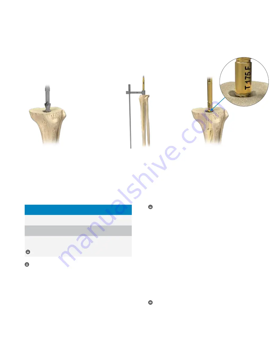 Zimmer Biomet Persona Surgical Technique Download Page 11