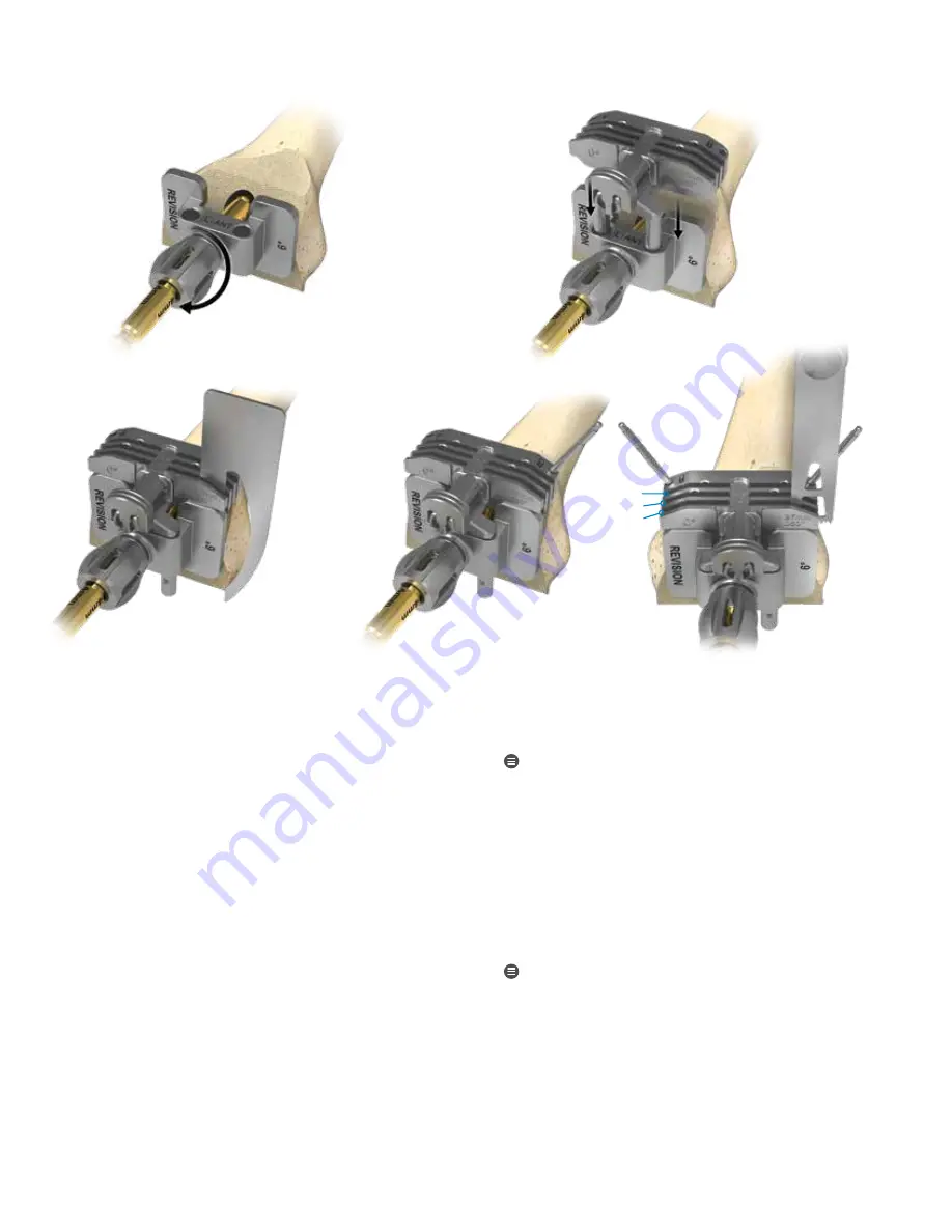 Zimmer Biomet Persona Surgical Technique Download Page 24