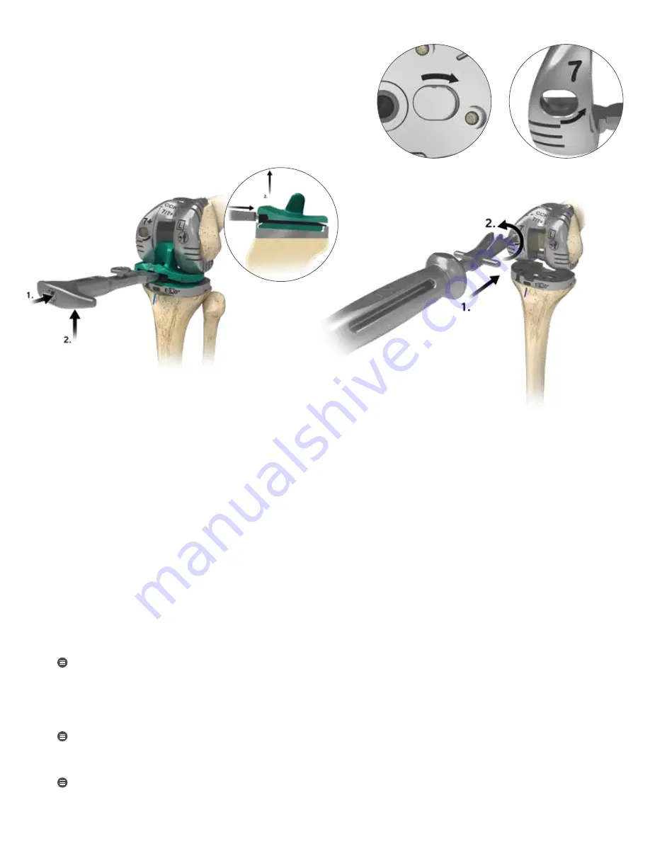 Zimmer Biomet Persona Surgical Technique Download Page 38