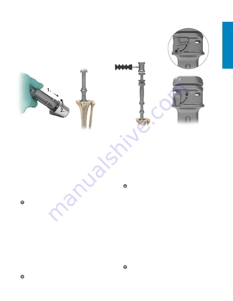 Zimmer Biomet Persona Surgical Technique Download Page 53